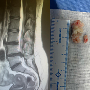 Lumbar Key Hole Discectomy