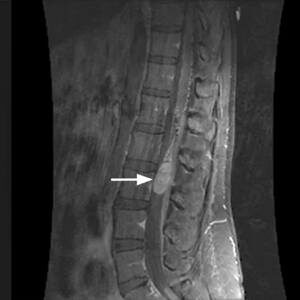 Spinal Cord Tumour