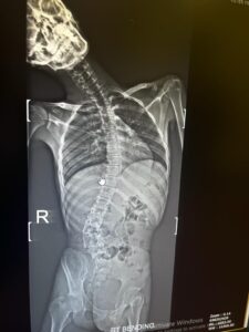 scoliosis surgery