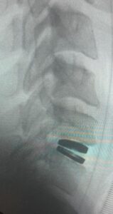 Cervical disc replacement surgery